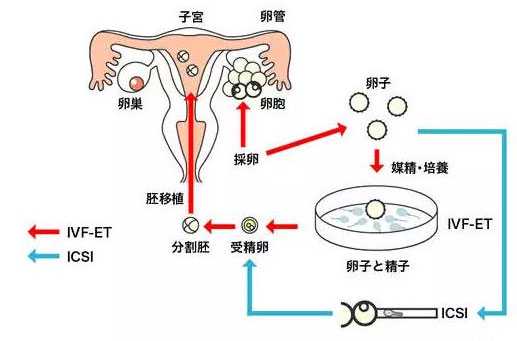 我国首例试管婴儿诞生已30余年