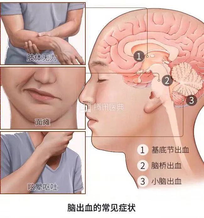网红突发脑出血事件