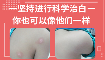 白斑病最新疗法，科技重塑健康之路