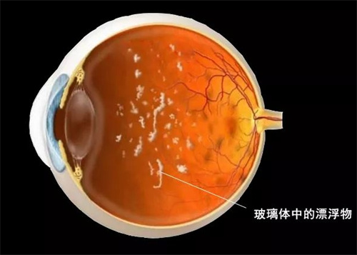 玻璃体混浊最新特效药治疗指南